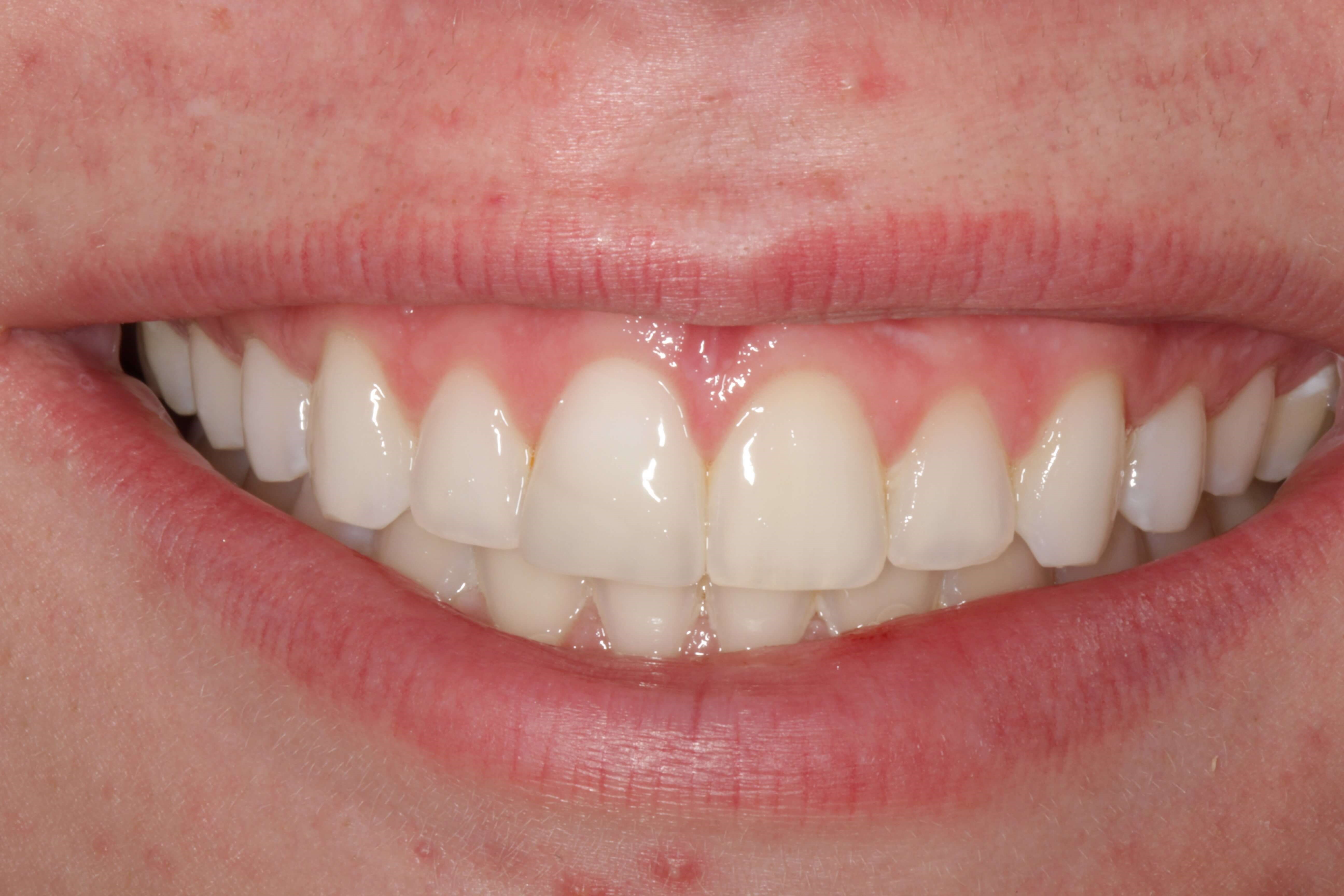 Broken Front Tooth After