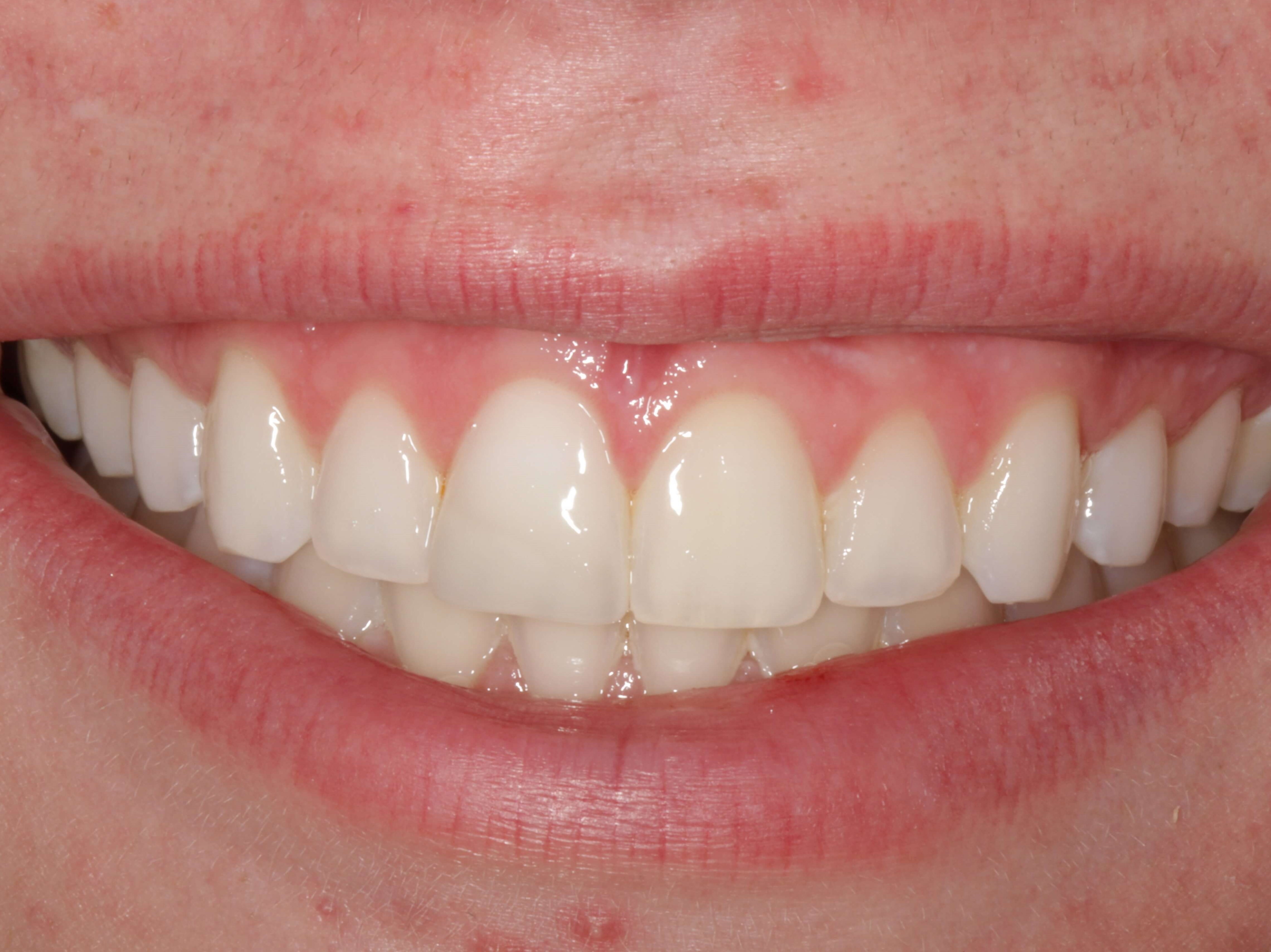 Broken Front Tooth After