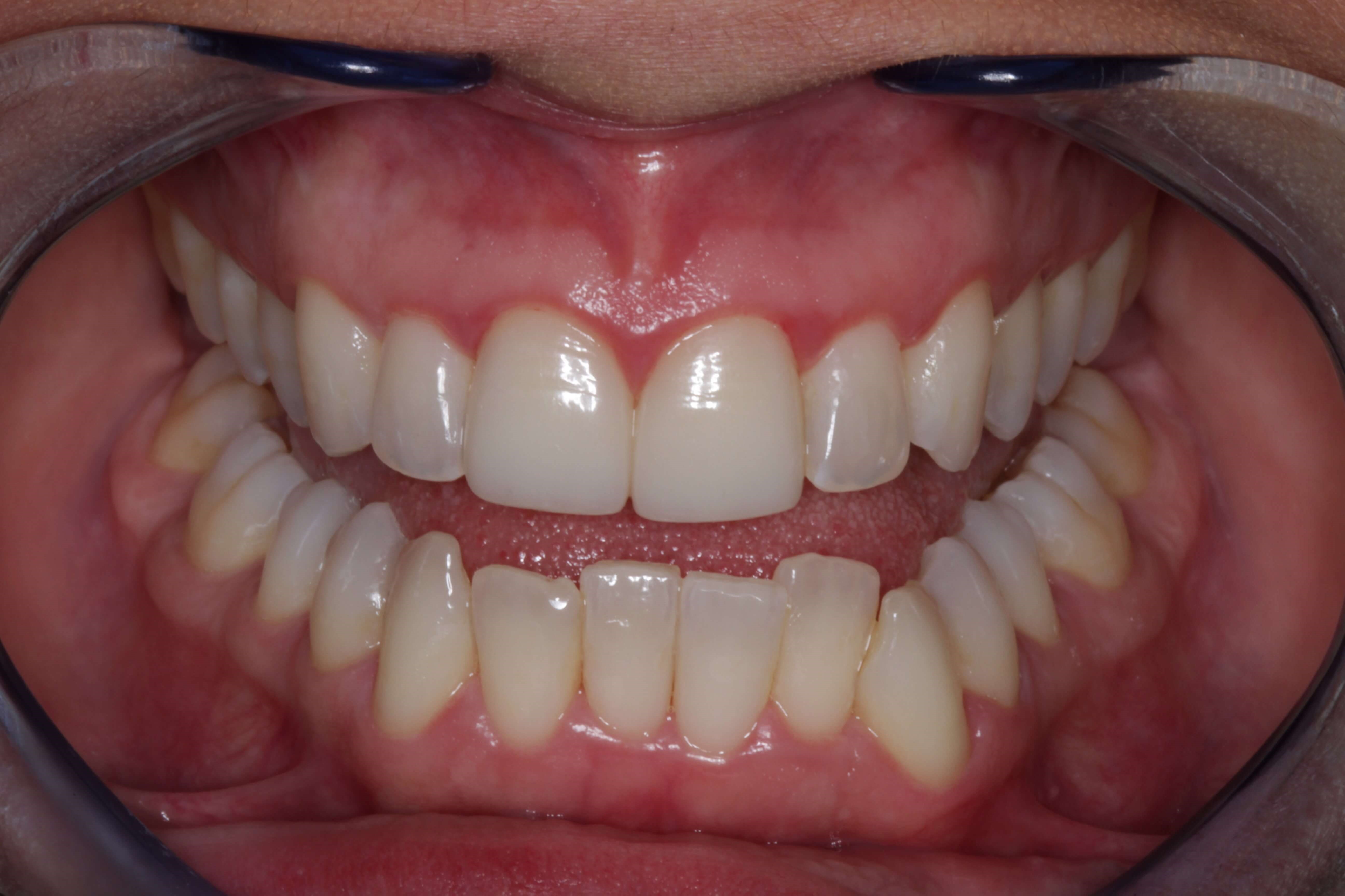 Before and After Photos Before Orthodontics