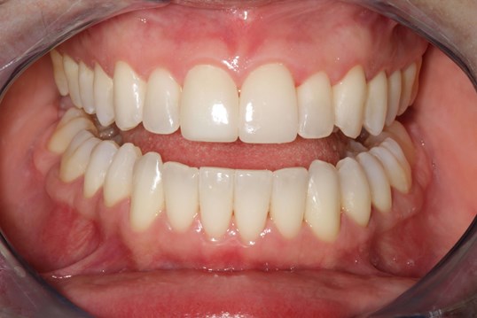 Before and After Photos After Ortho and Cosmetic Work