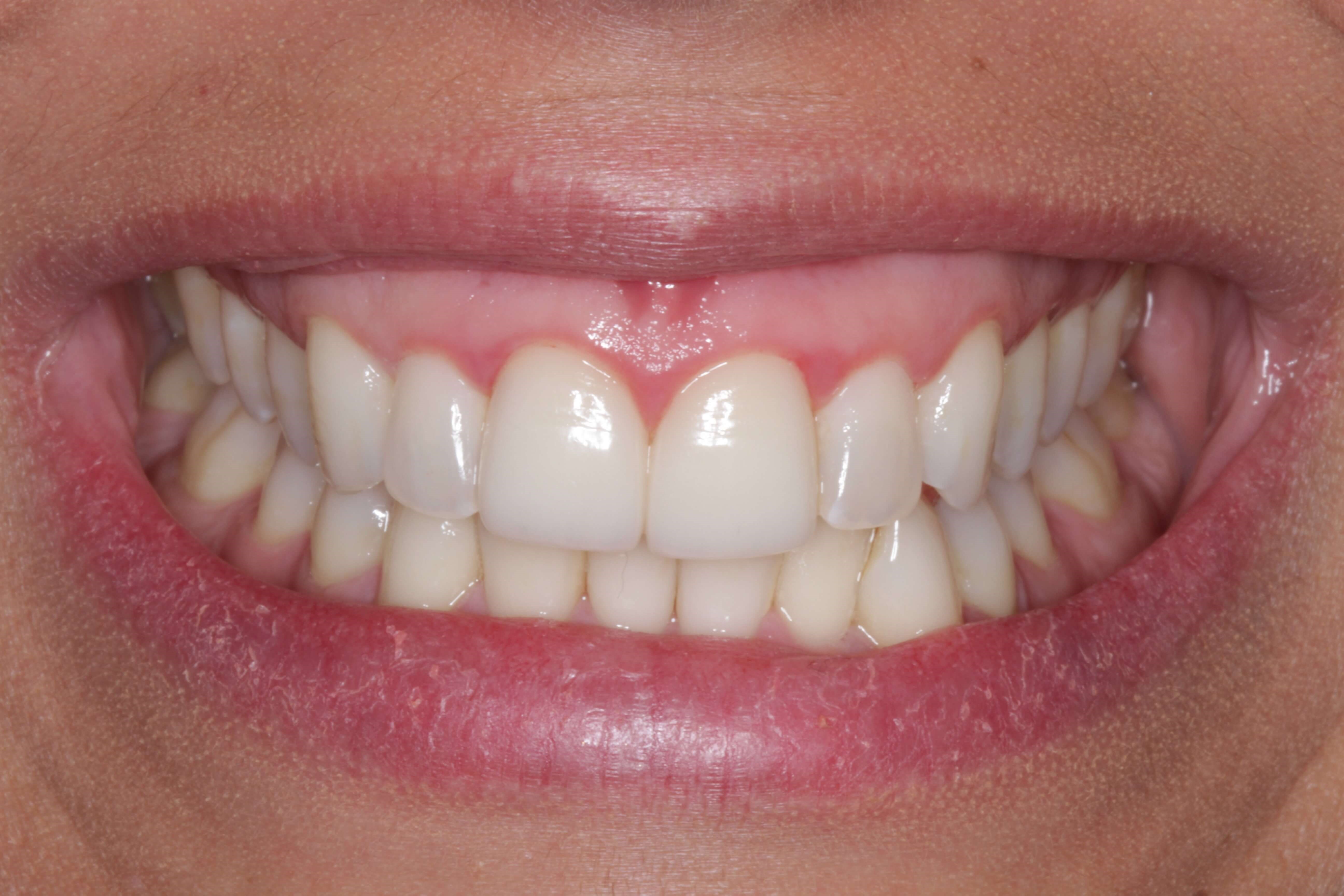 Before and After Photos Before Orthodontics