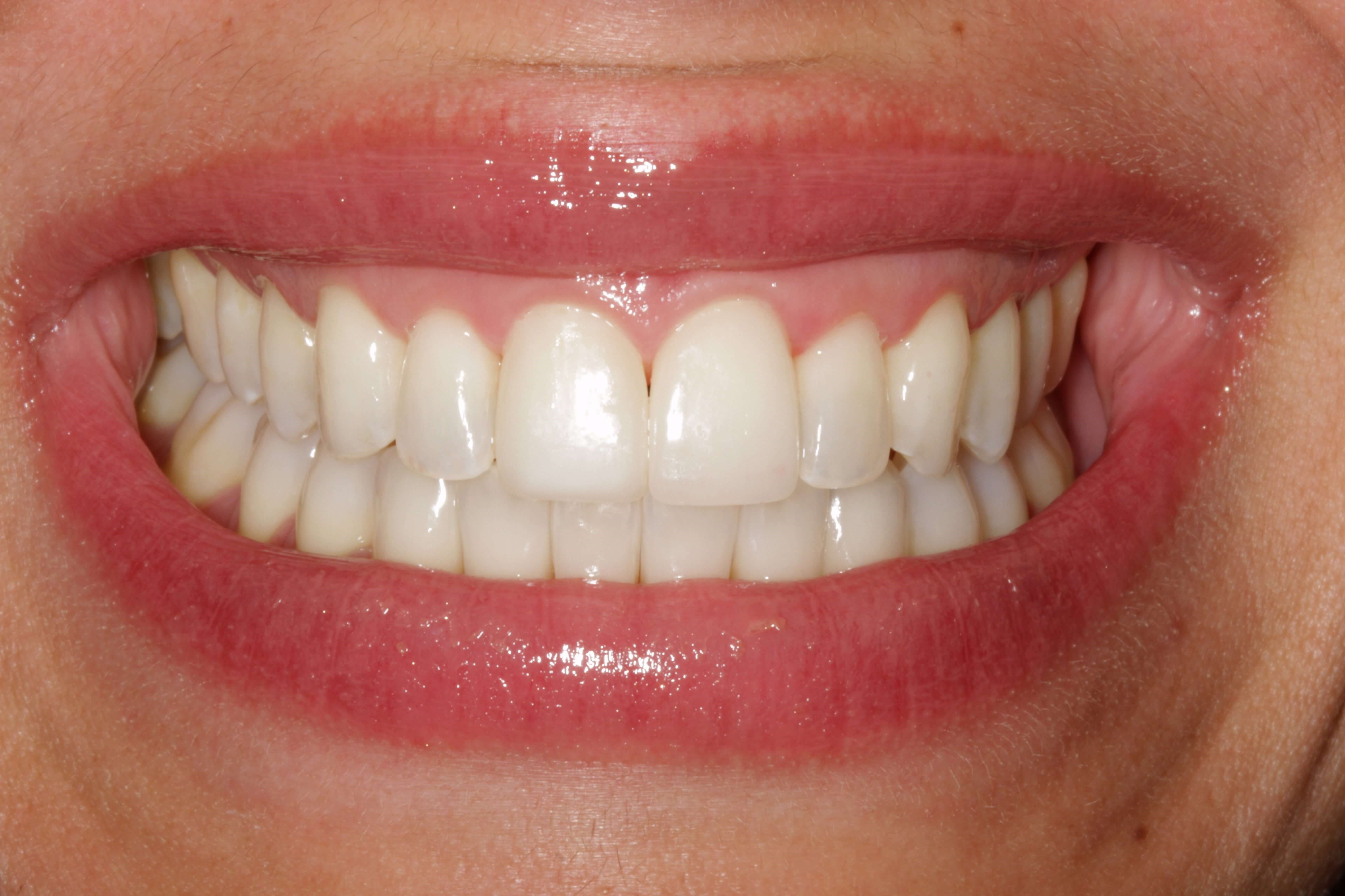 Before and After Photos After Ortho and Cosmetic Work