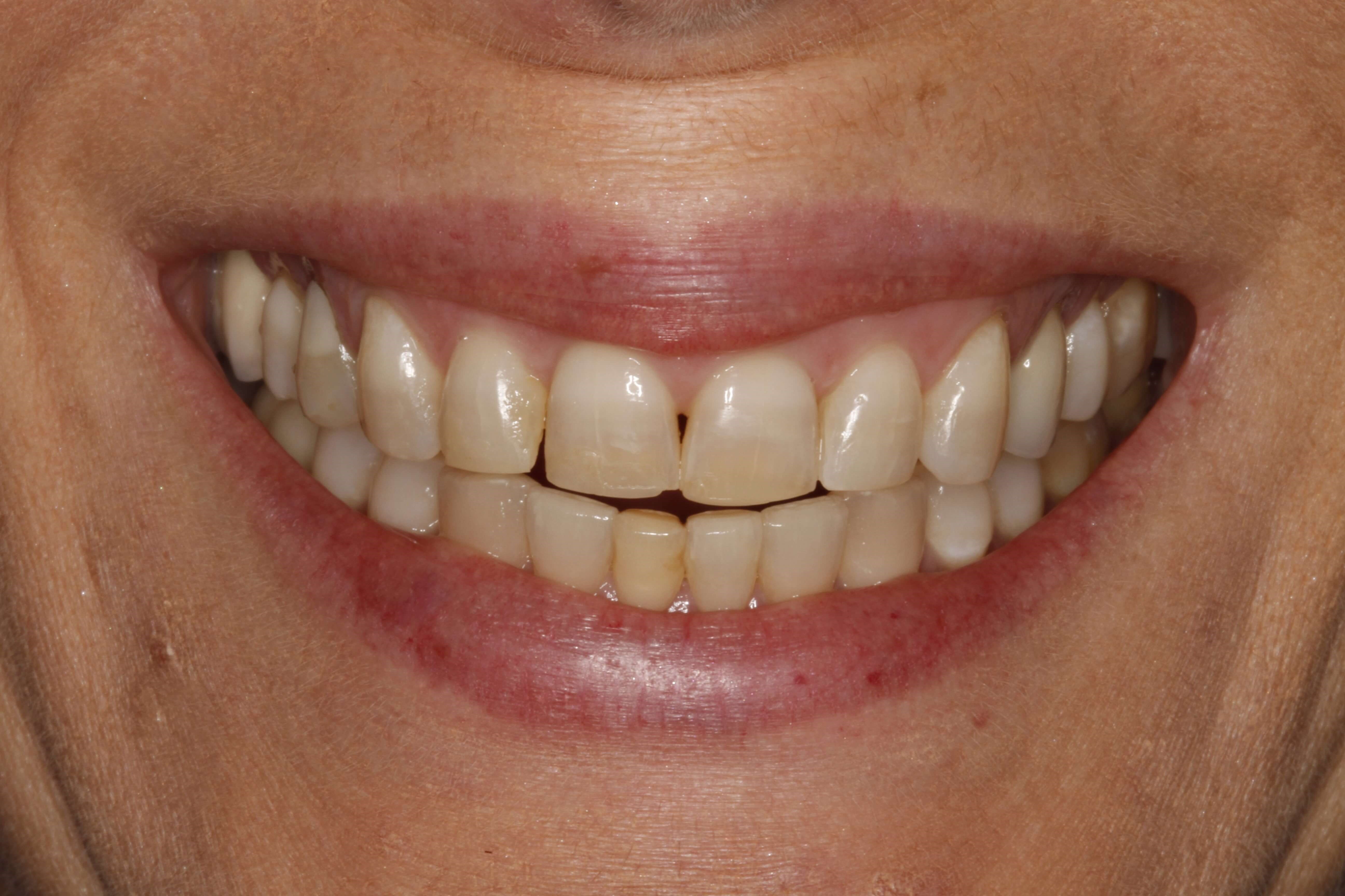 Before and After Before Orthodontics