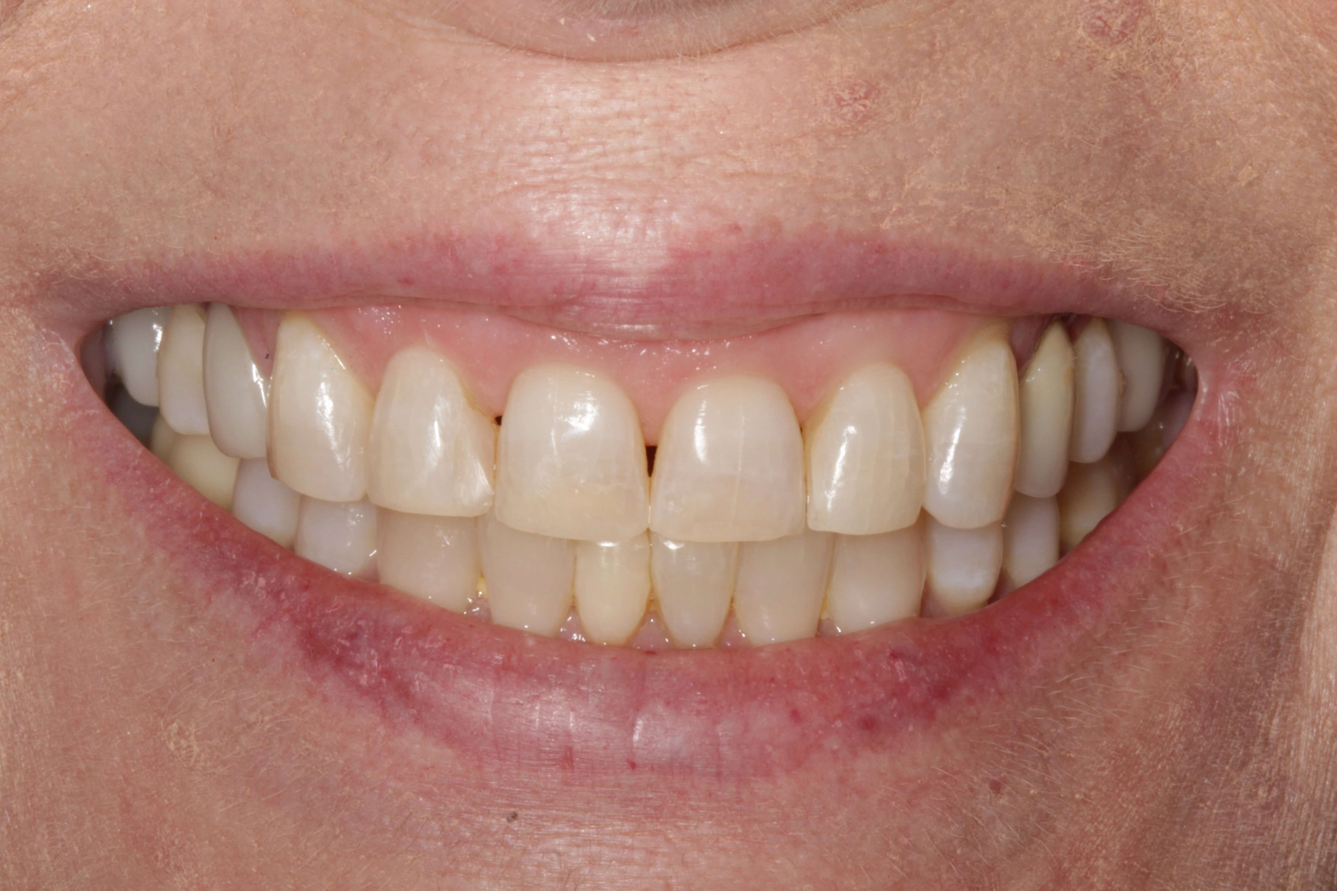 Before and After Cosmetic Work After Orthodontics