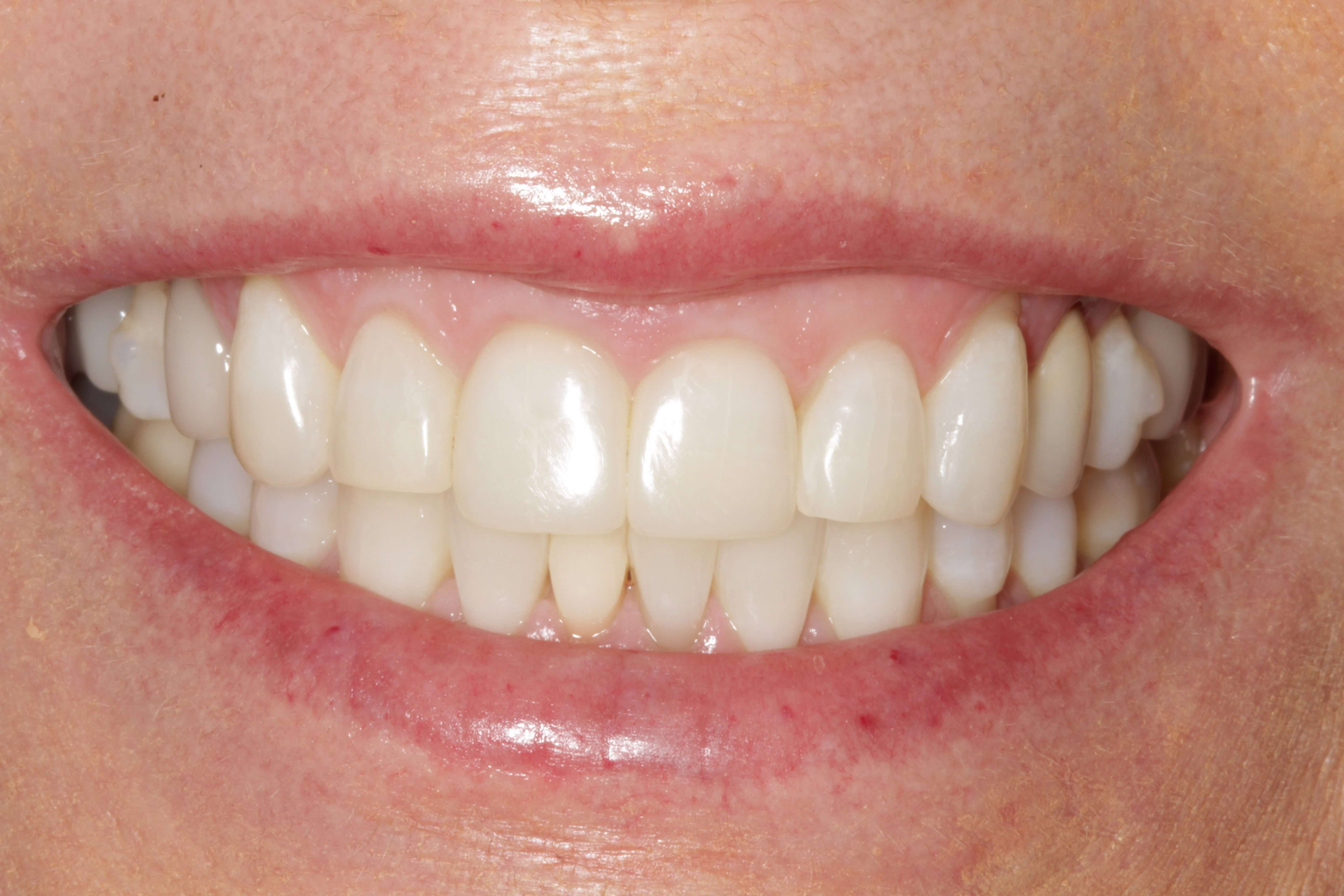 Before and After After Ortho and Cosmetic Work