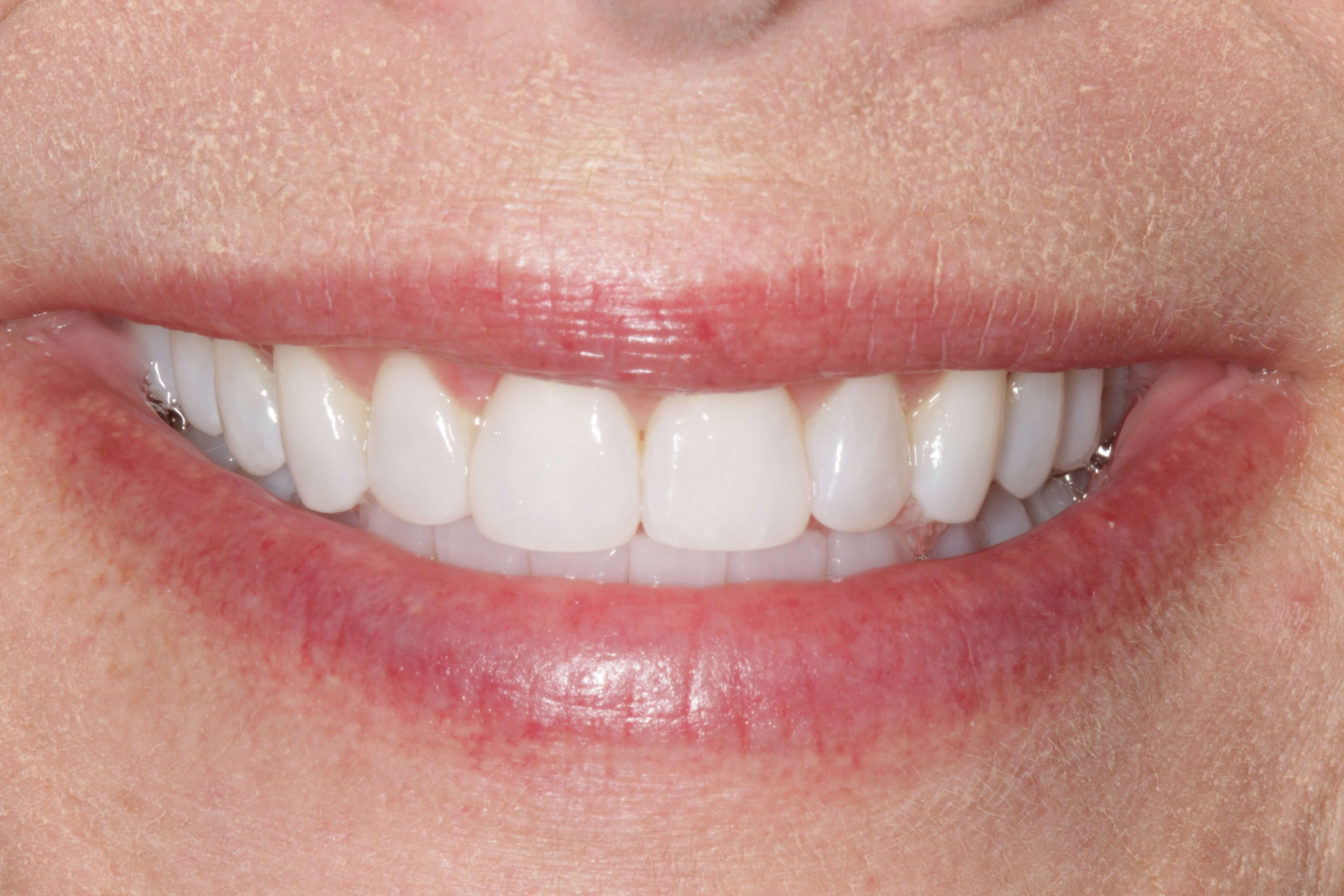 Smile Makeover After