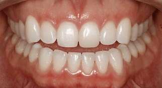 Cosmetic Bonding After