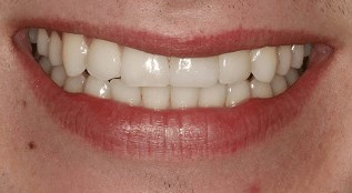 Before & After - Implant After