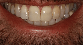 KOR Whitening Before