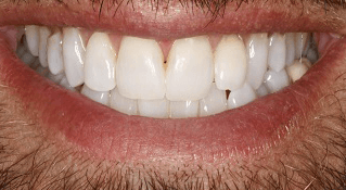 KOR Whitening After