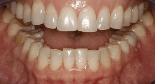 KOR Whitening Before