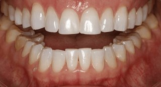 KOR Whitening After