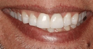 Smile Makeover B & A After