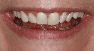 Smile Makeover B & A Before