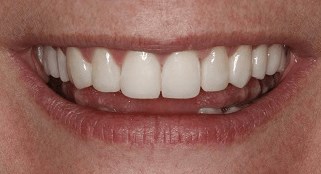 Smile Makeover B & A After