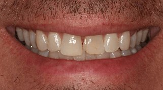 Veneers Before and After Before