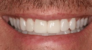 Veneers Before and After After
