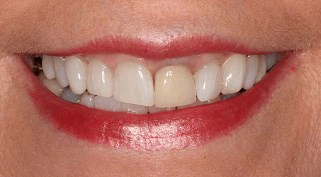 Smile Makeover B & A Before