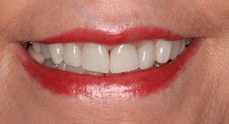 Smile Makeover B & A After