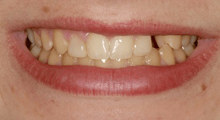 Smile Makeover B & A Before