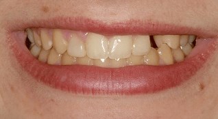 Smile Makeover B & A Before