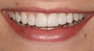 Smile Makeover B & A After