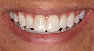 Before & After After