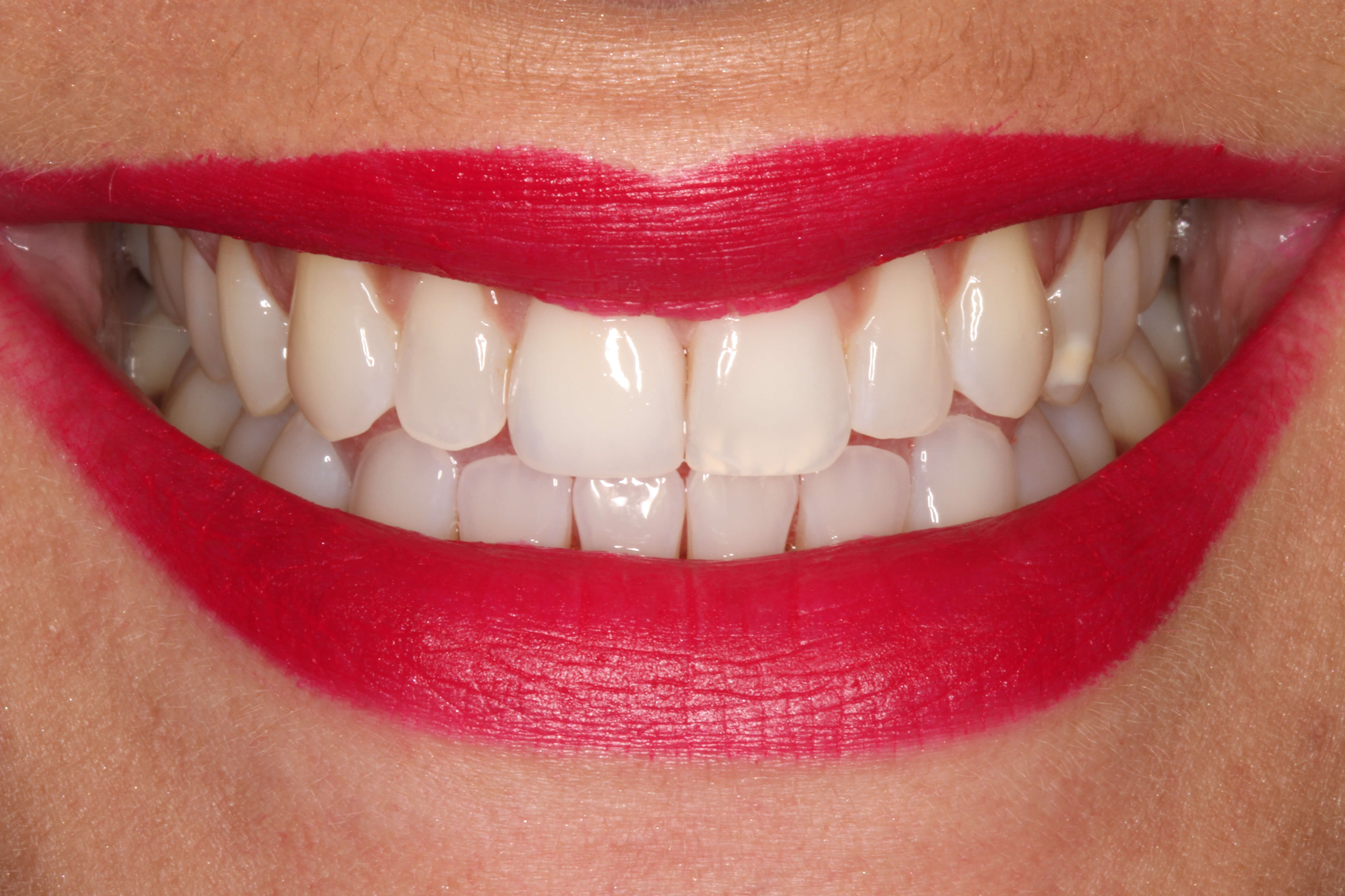 Smile Makeover B & A After