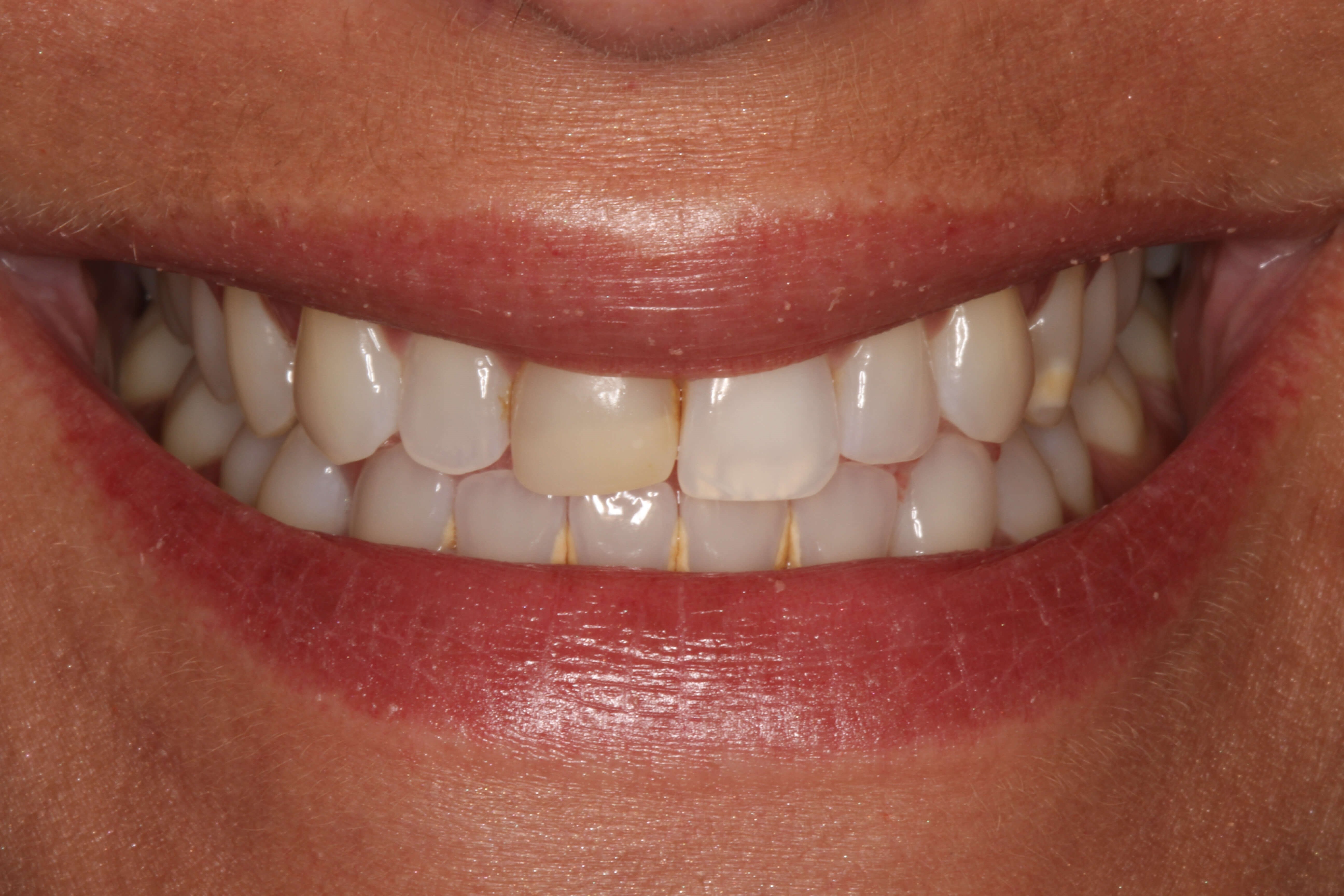 Smile Makeover B & A Before