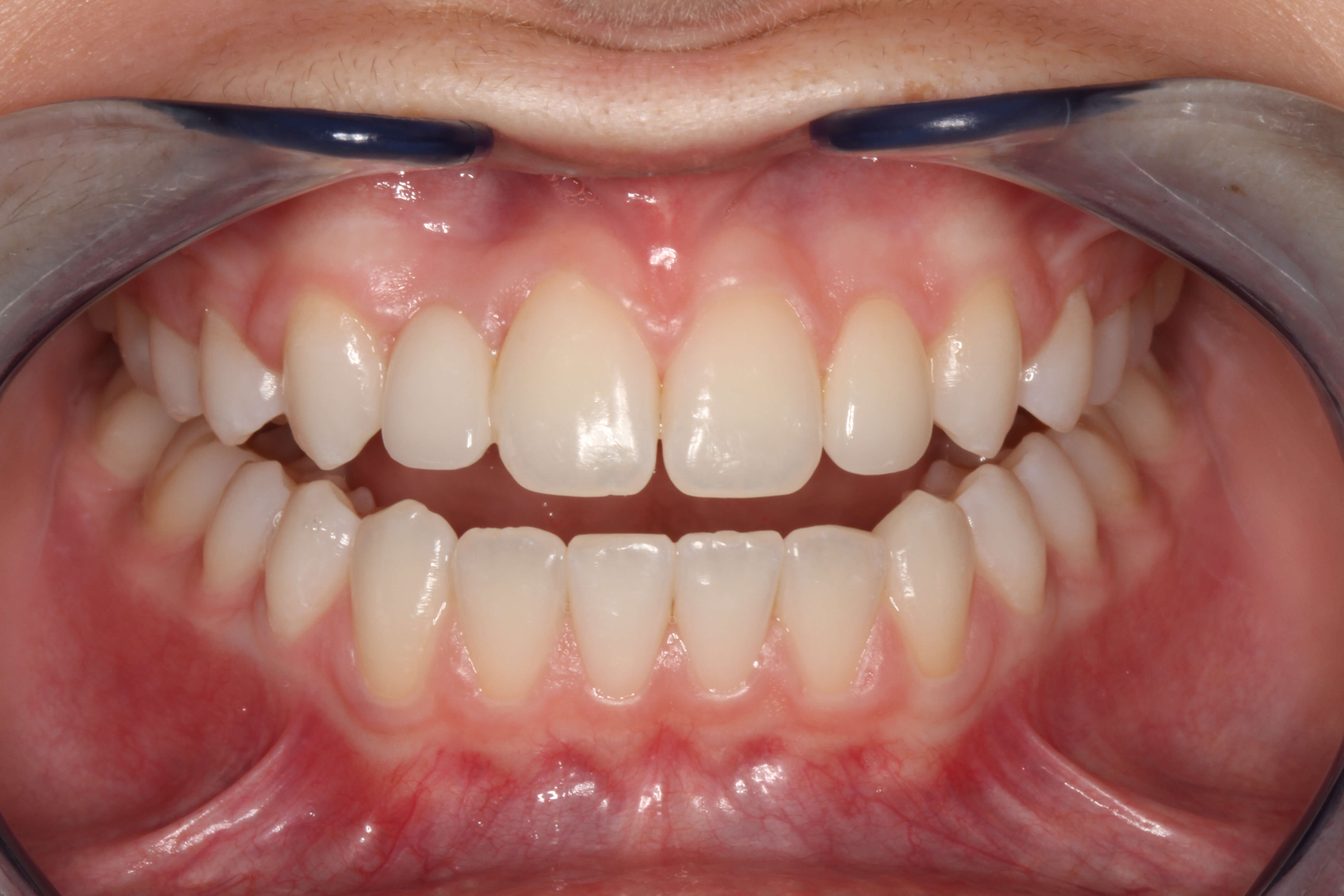 Smile Makeover B & A After