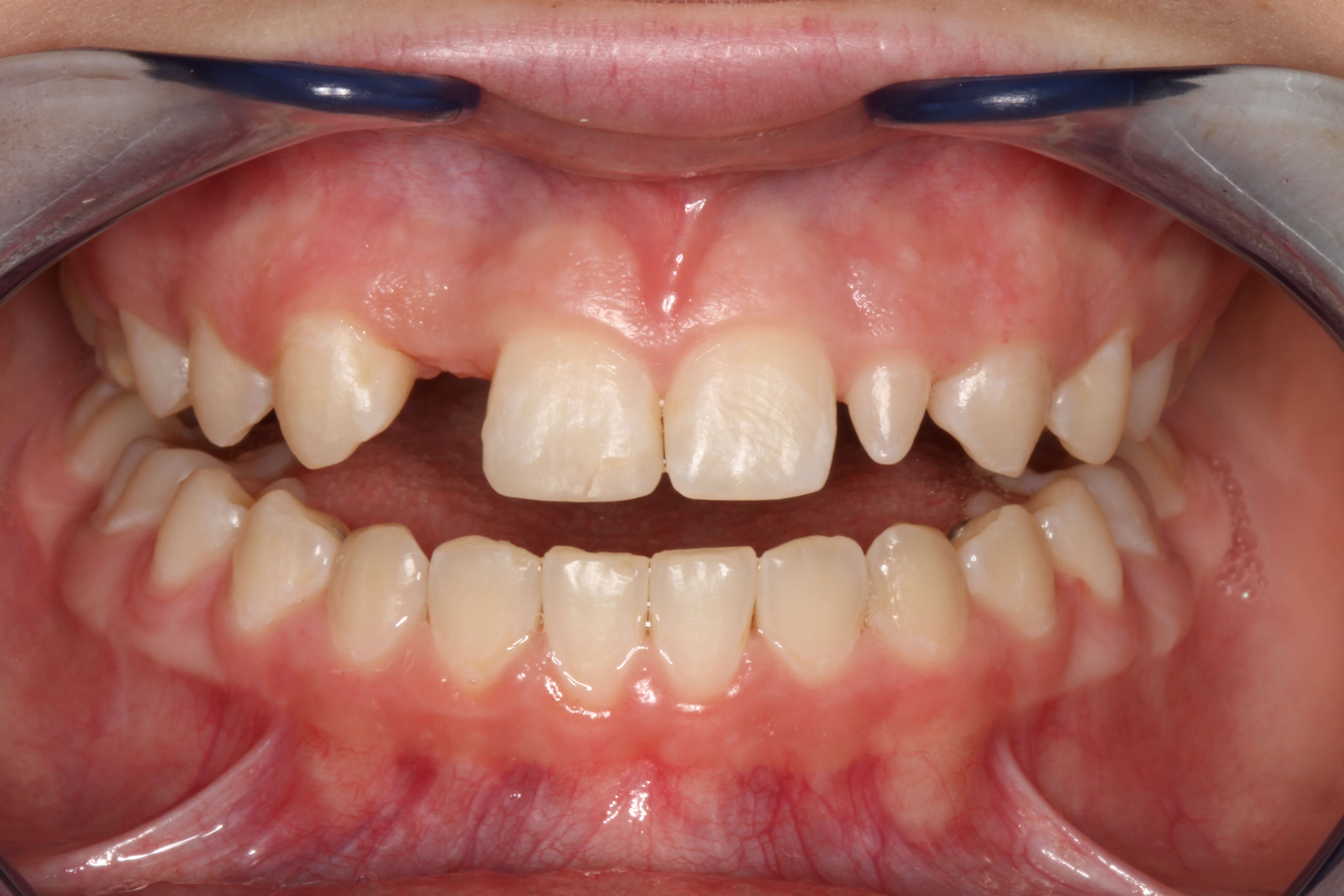 Smile Makeover B & A Before