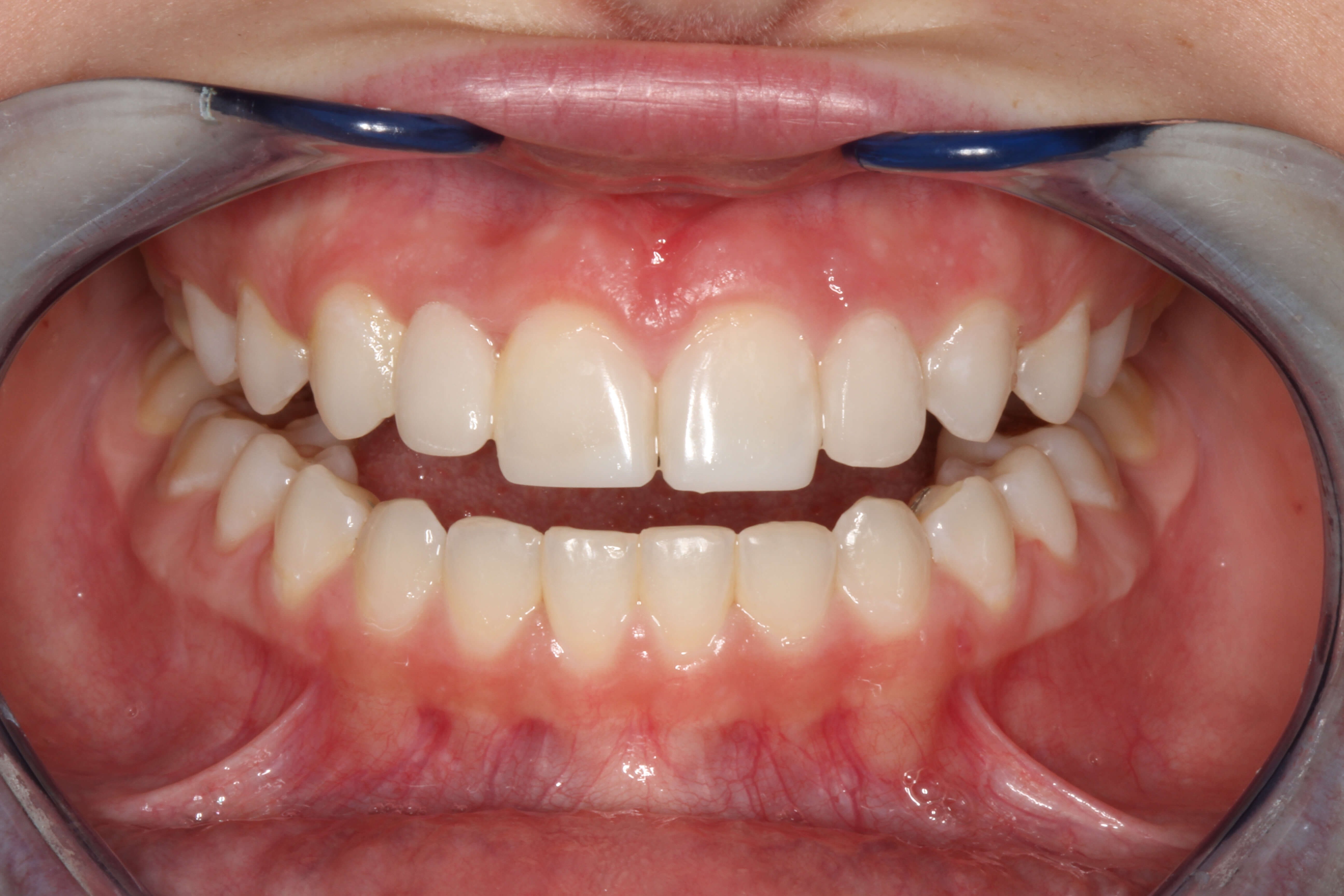 Smile Makeover B & A After