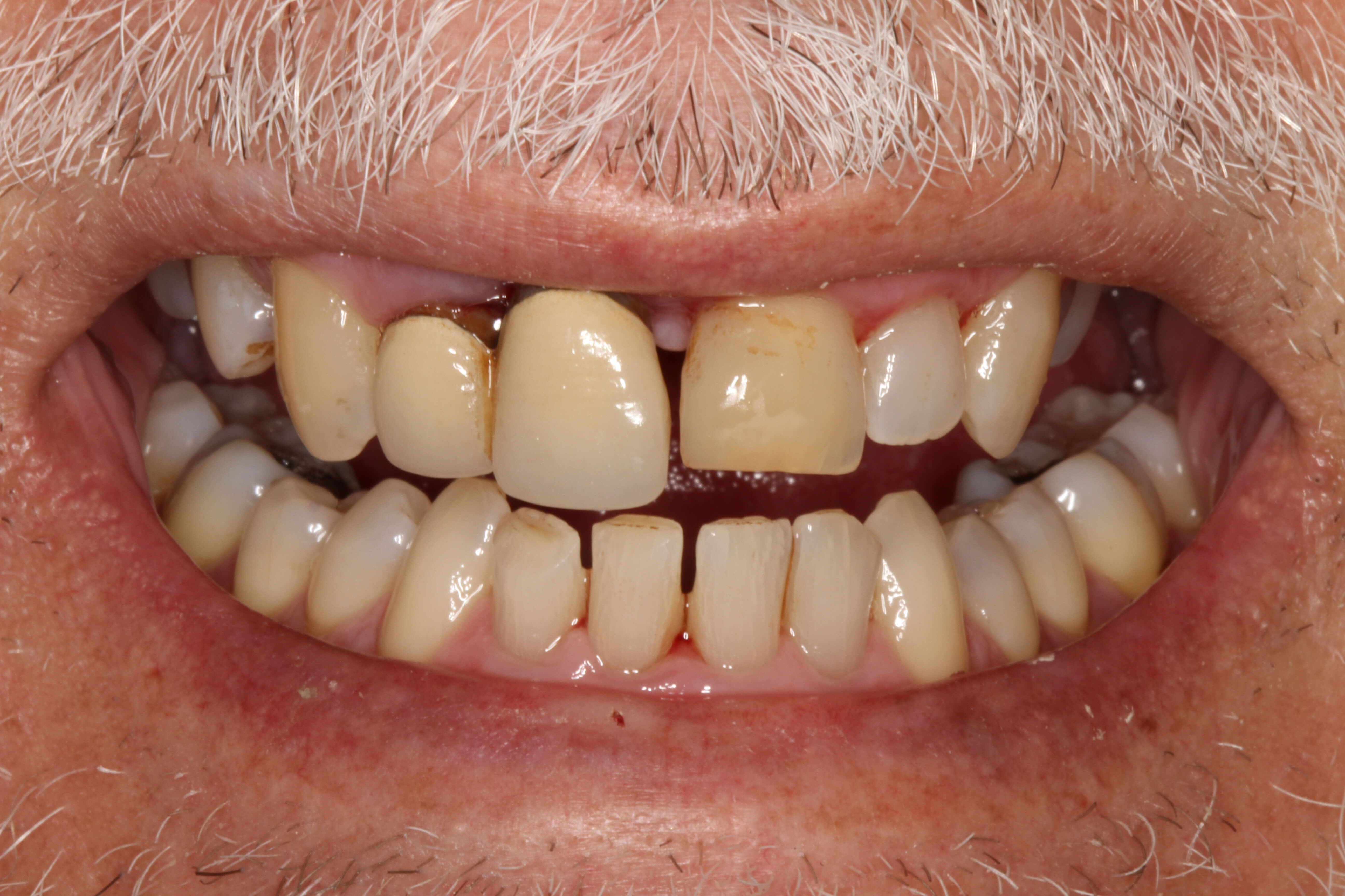 Smile Makeover B & A Before