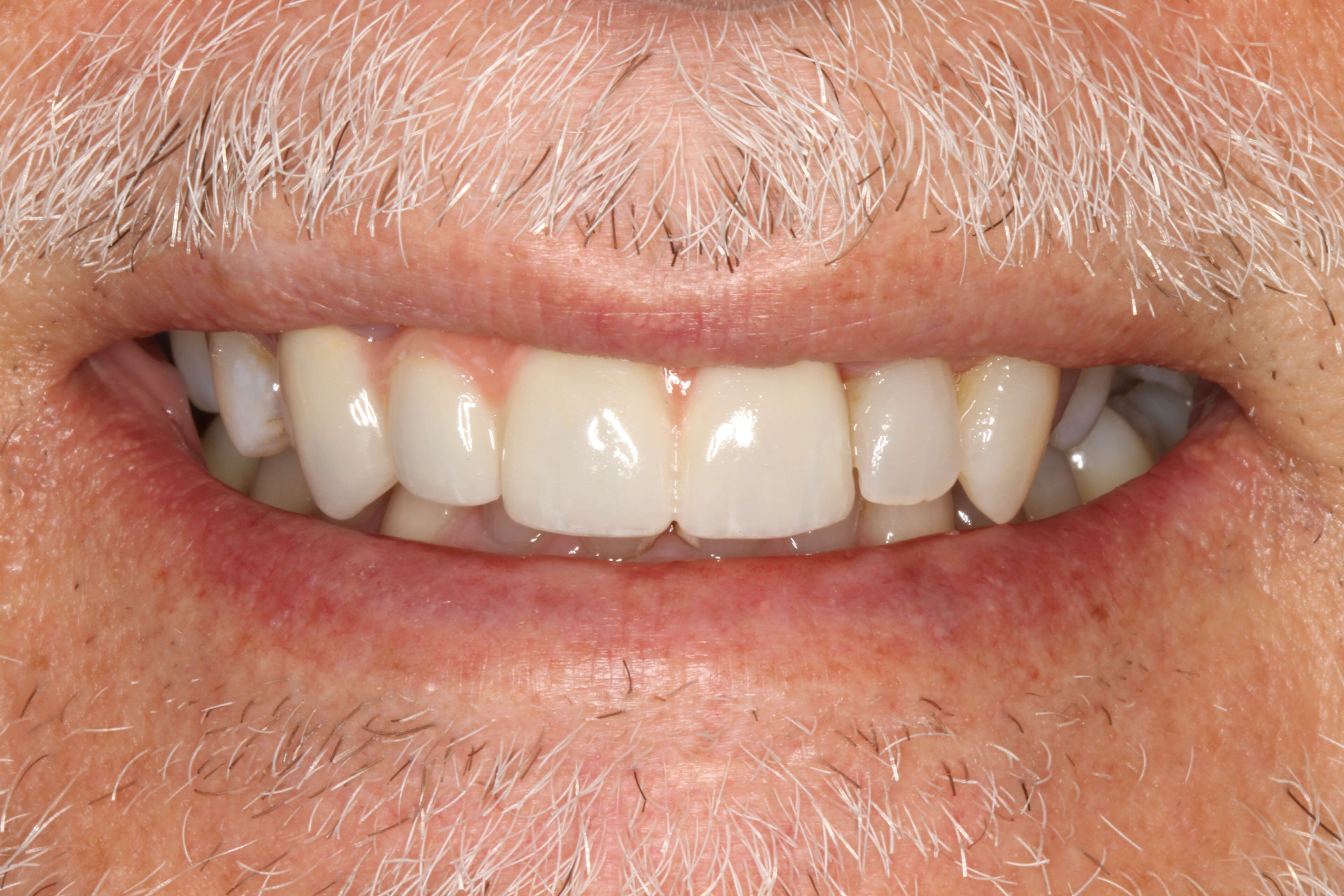 Smile Makeover B & A After