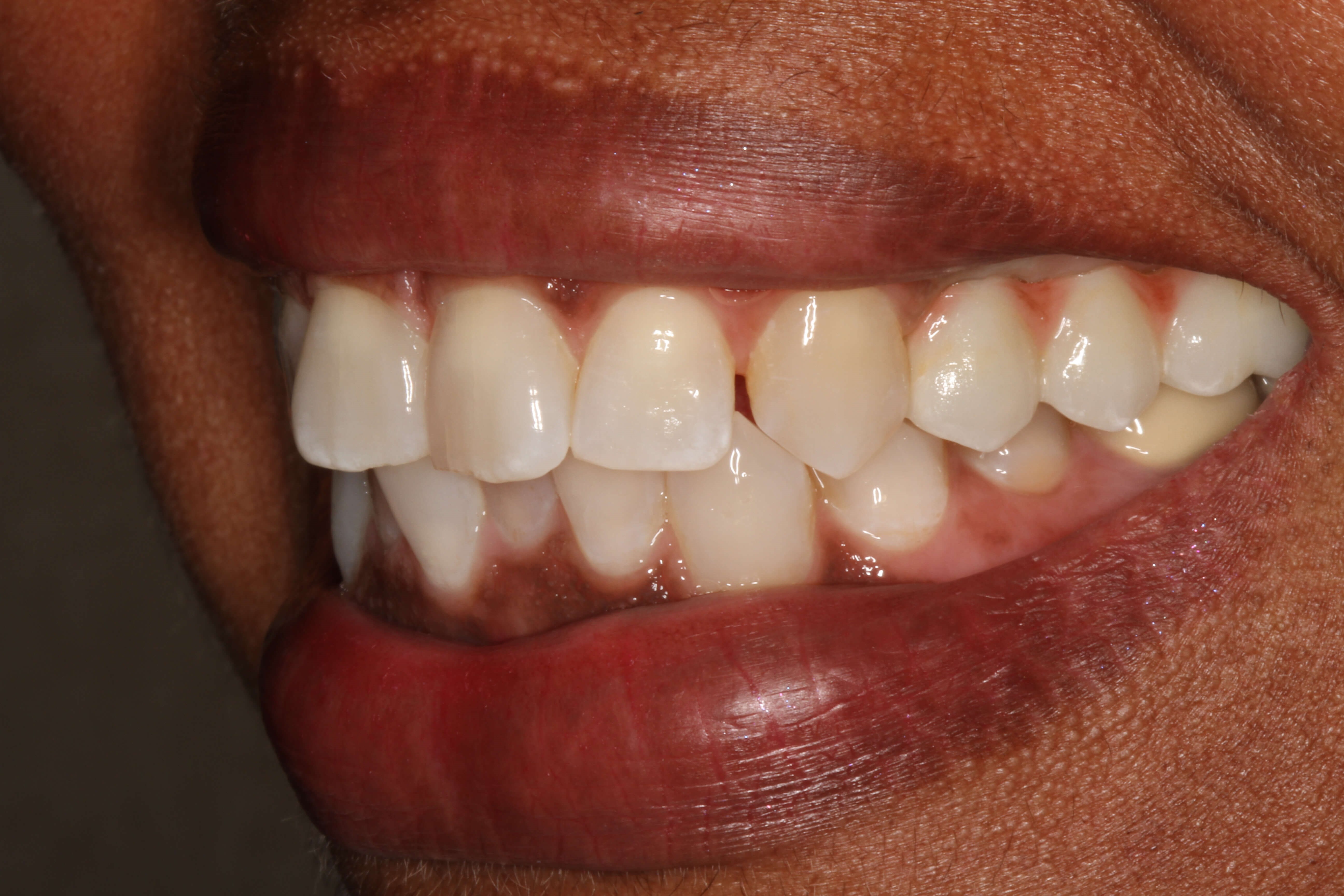 Before & After After