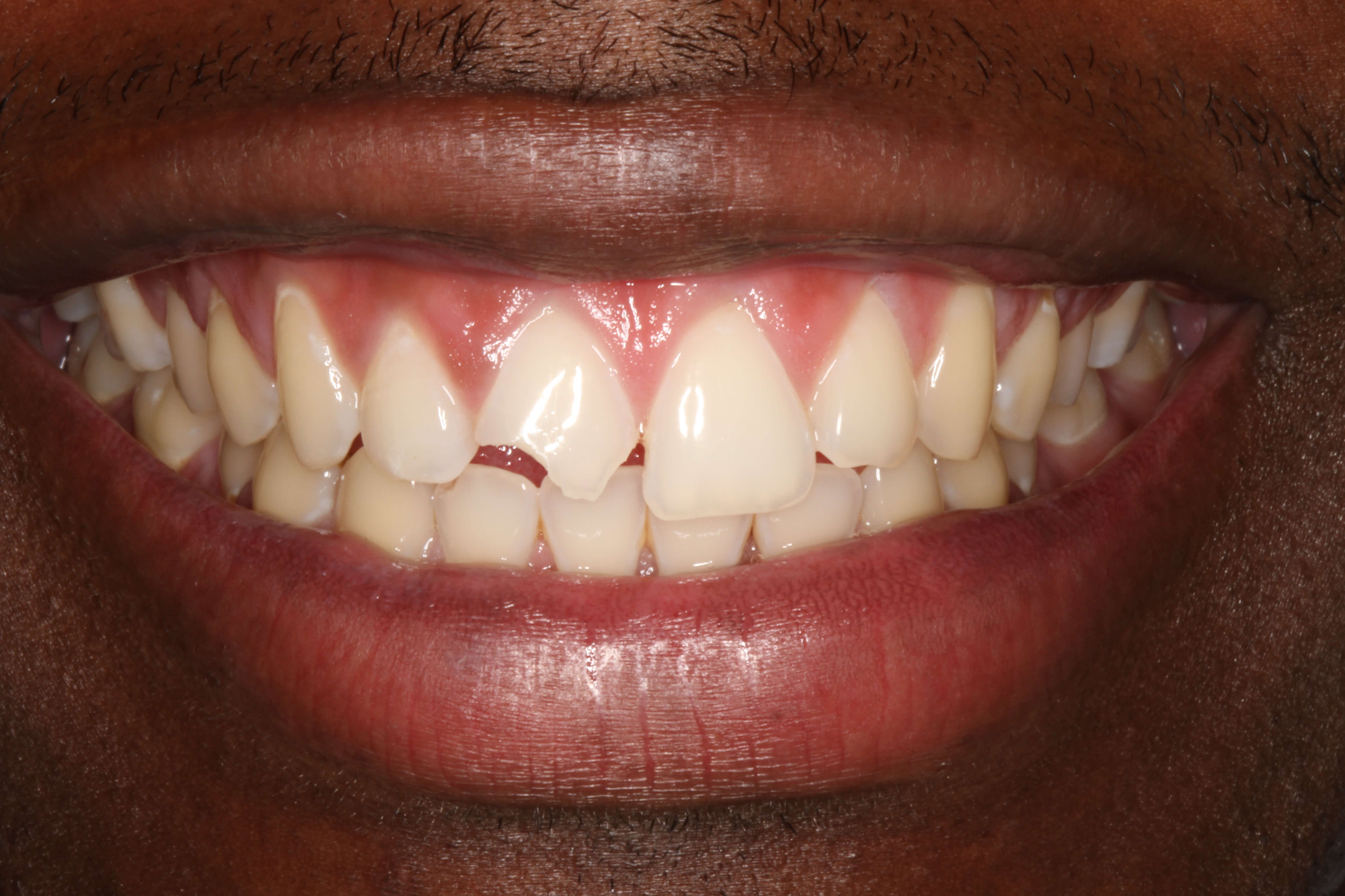 Smile Makeover B & A Before