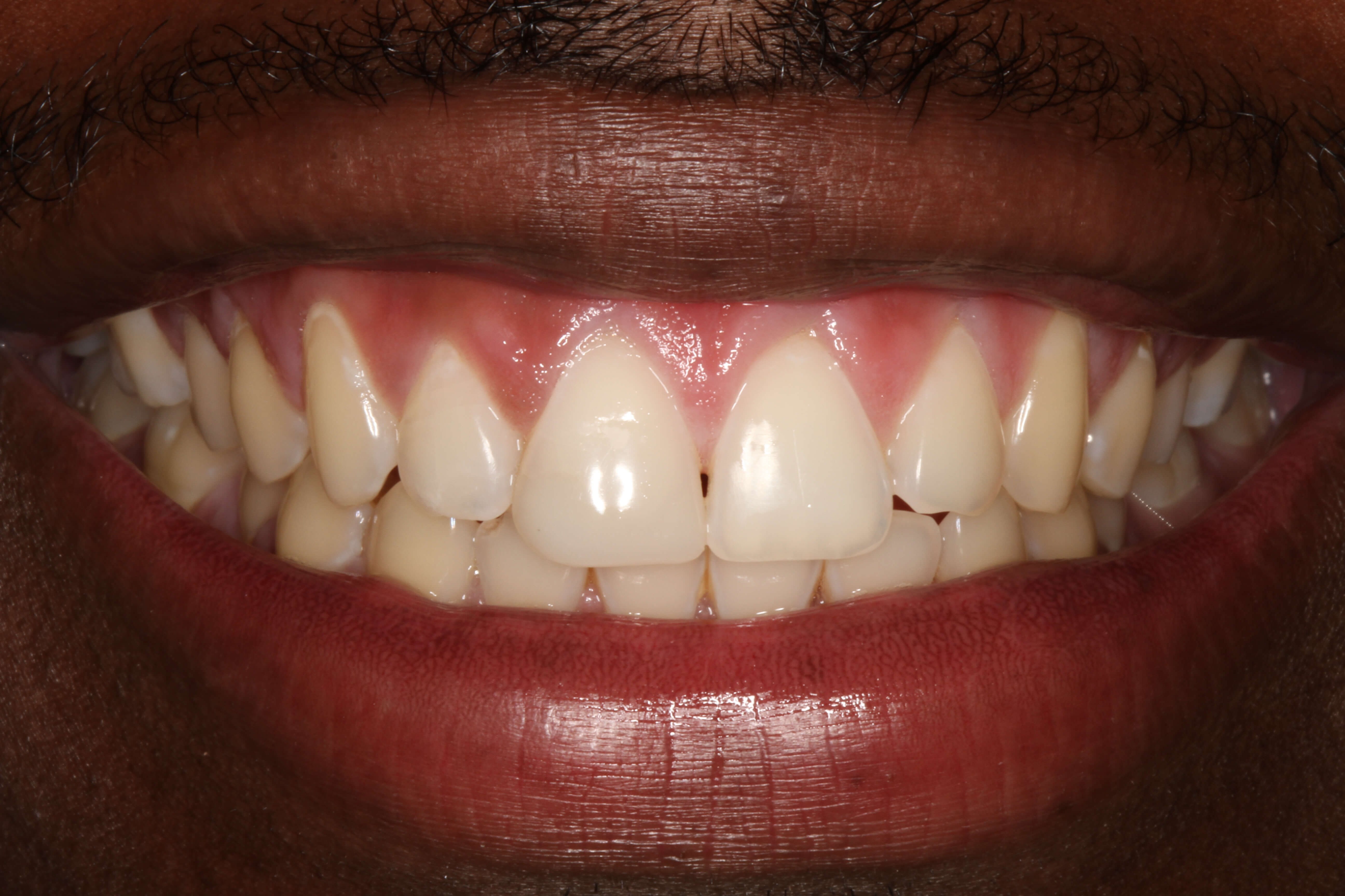 Smile Makeover B & A After