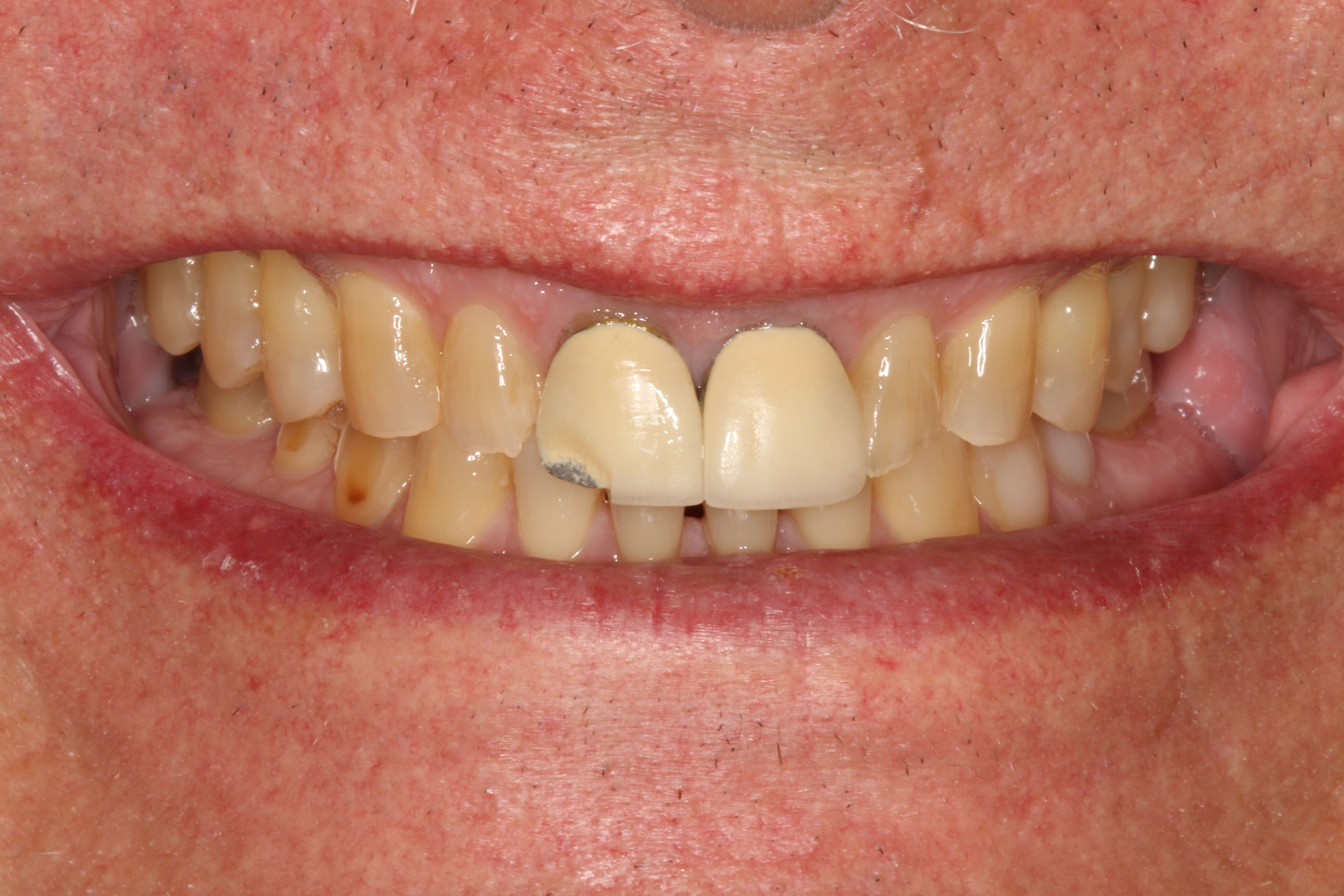 Smile Makeover B & A Before