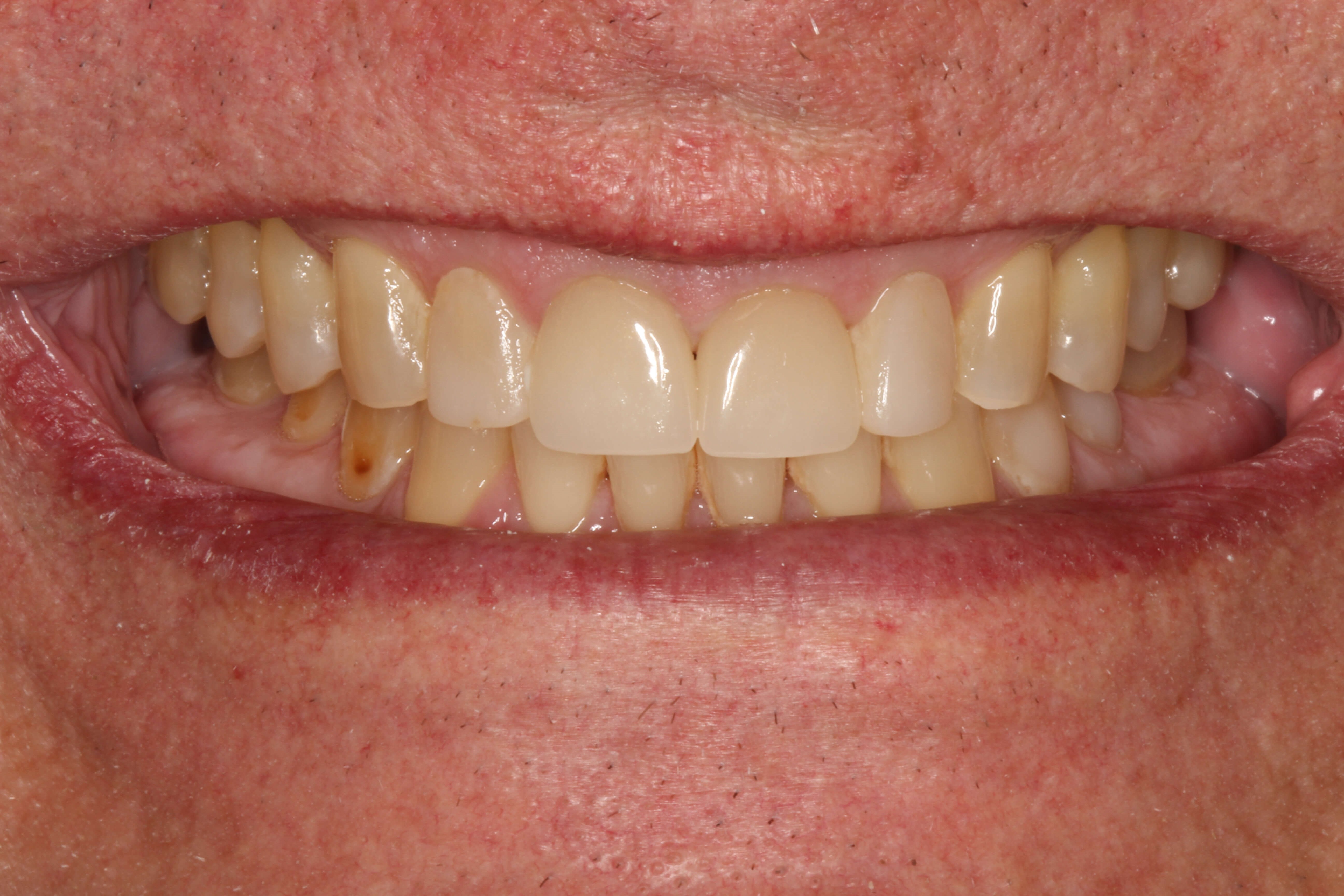 Smile Makeover B & A After