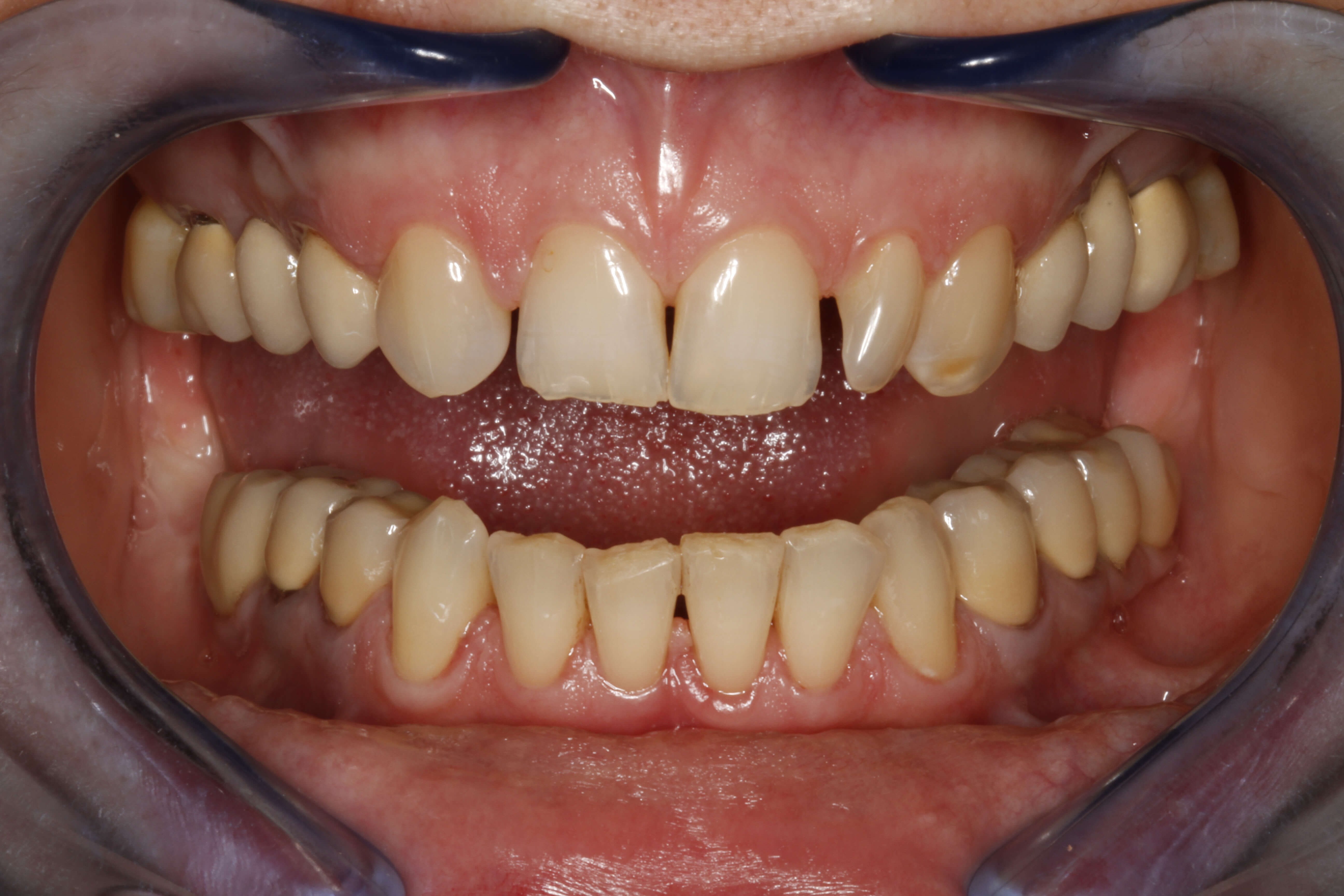 Smile Makeover Before