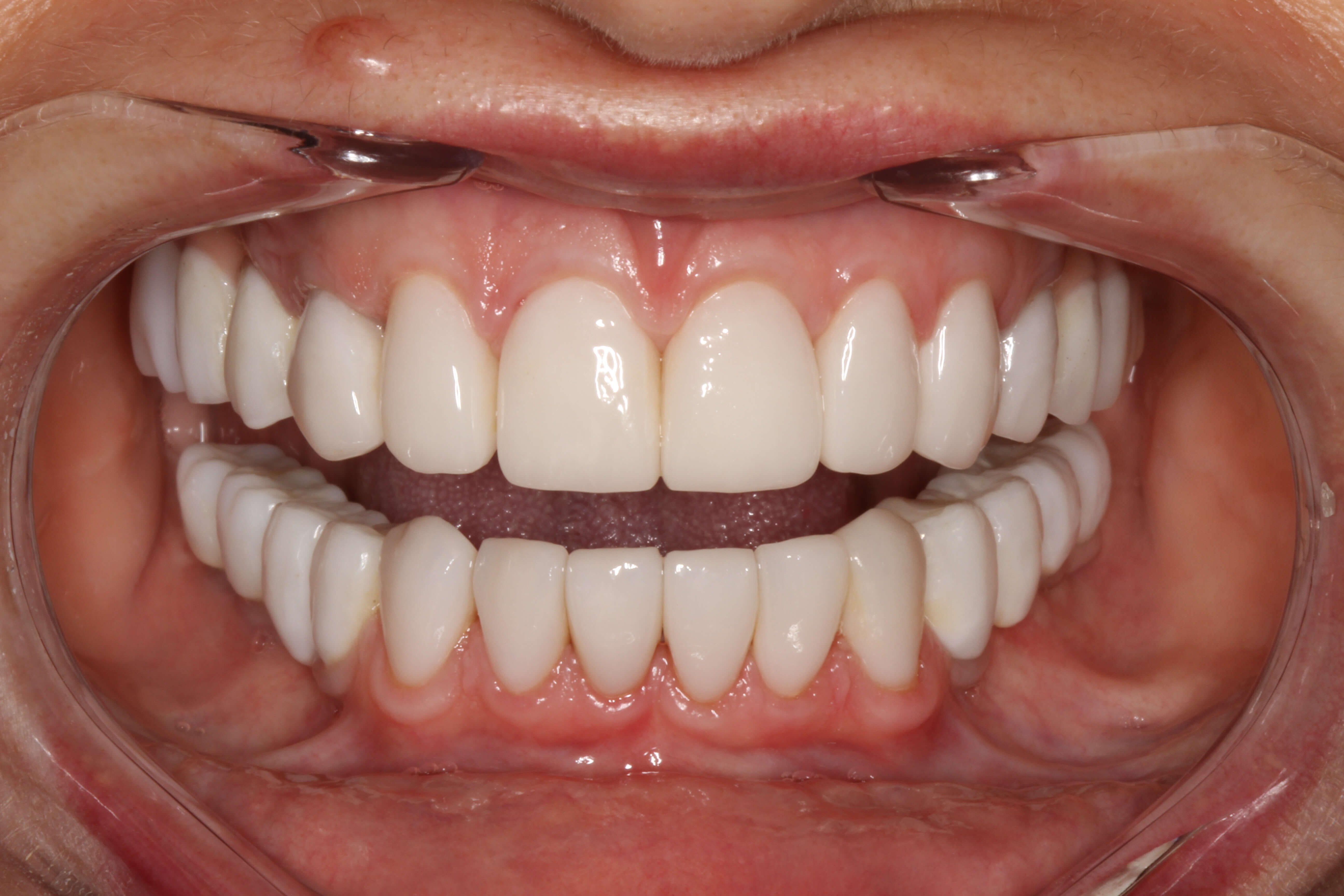 Smile Makeover After