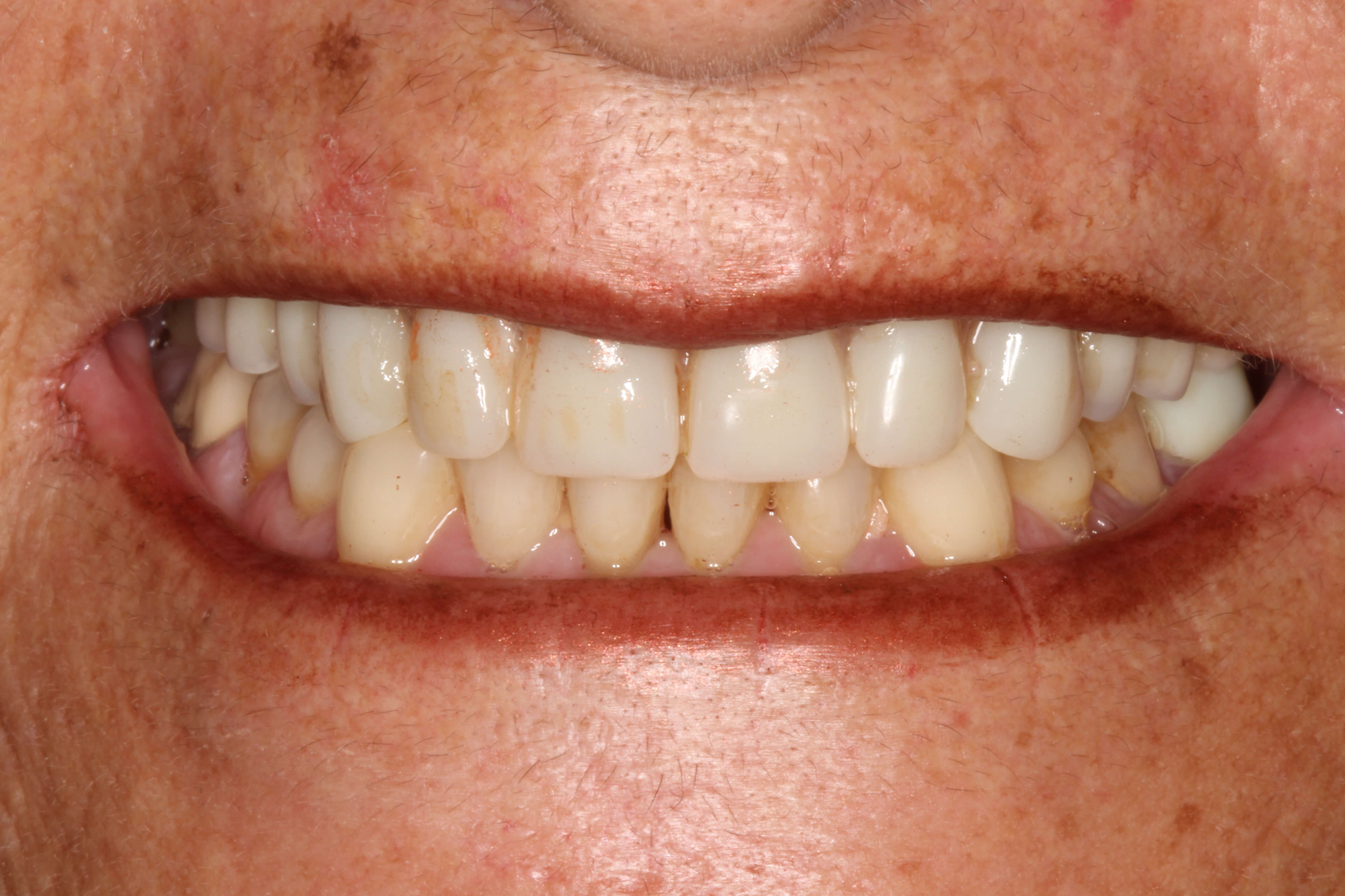 Smile Makeover B & A Before