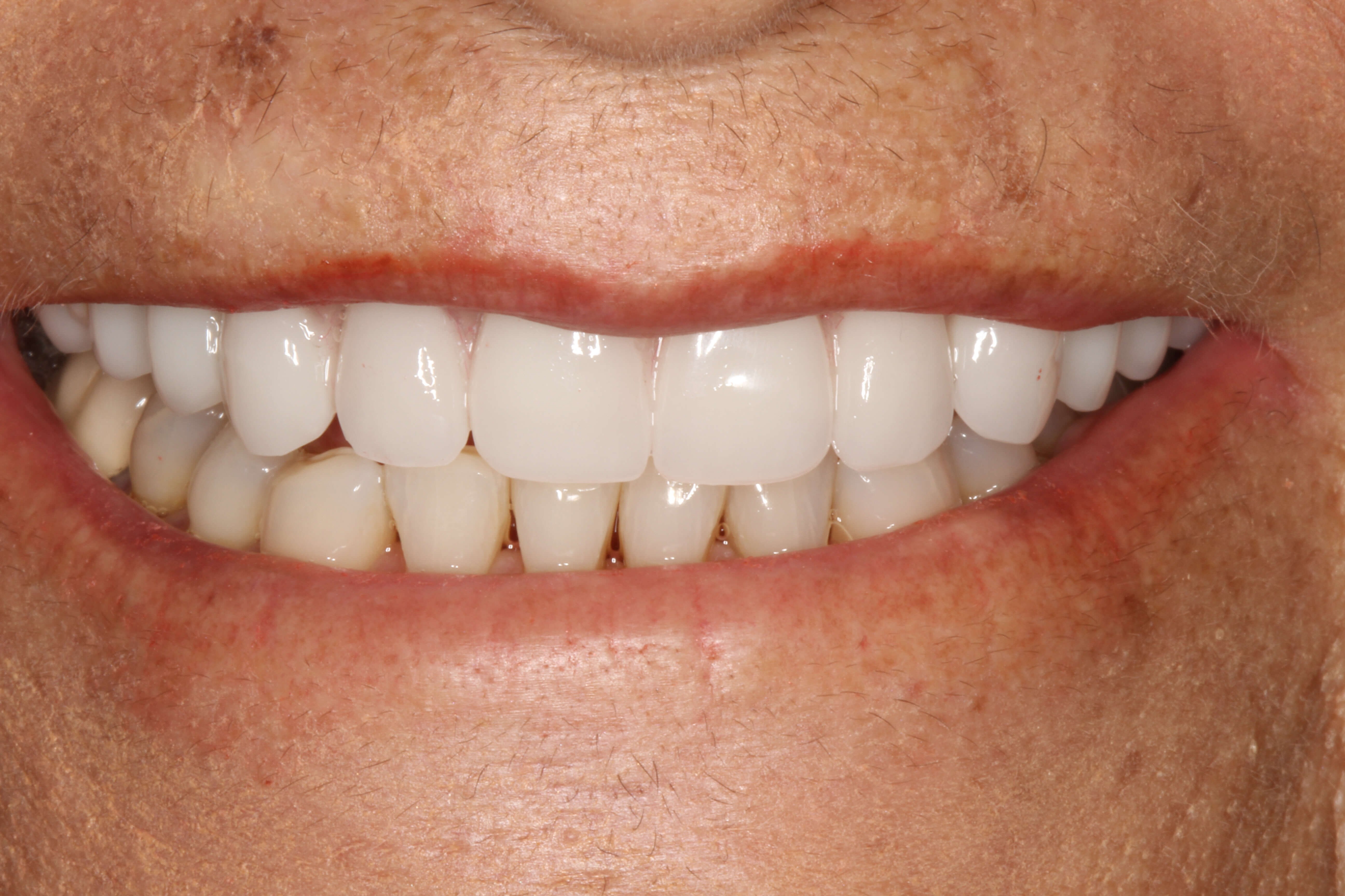 Smile Makeover B & A After