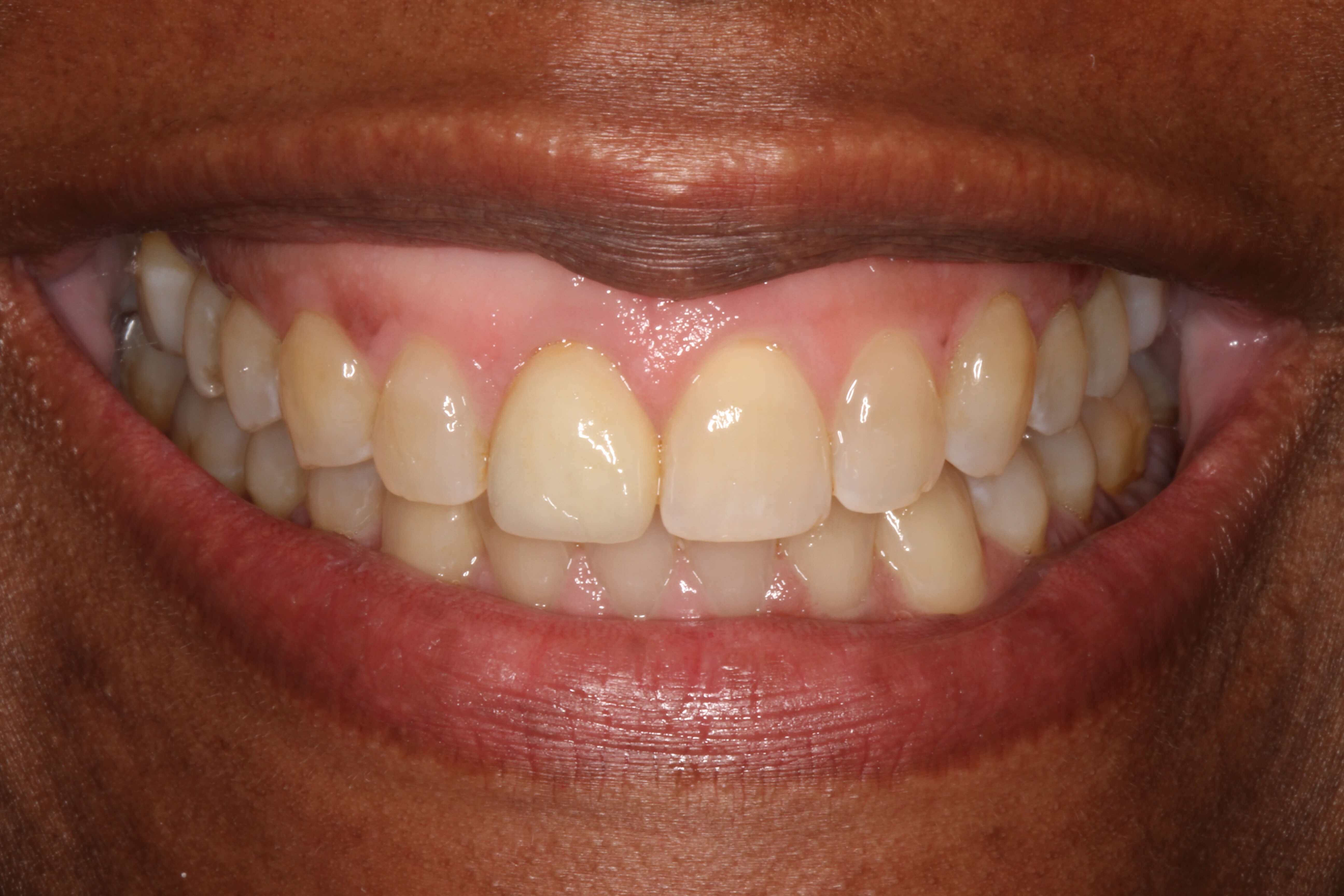 Smile Makeover Before