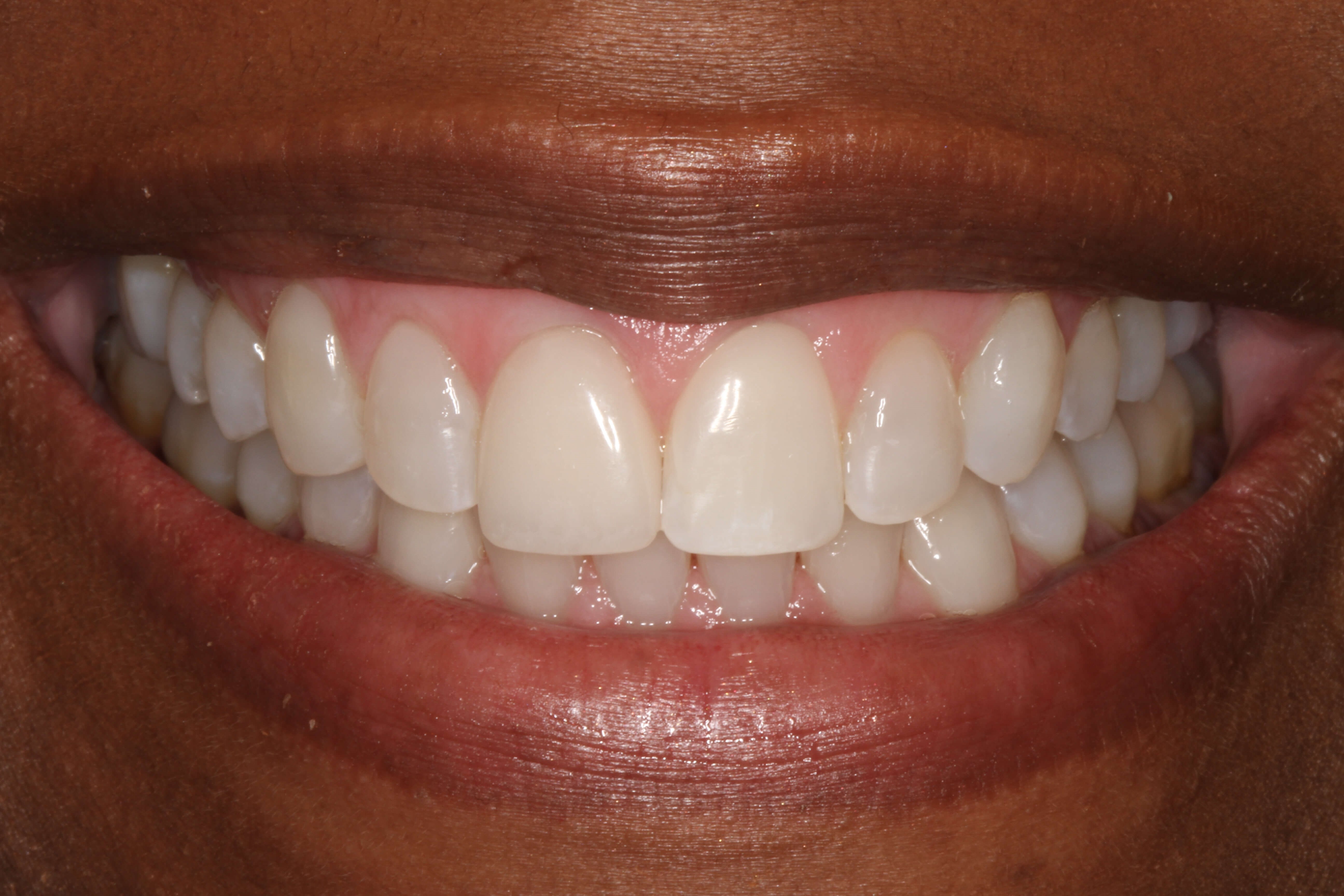 Smile Makeover After