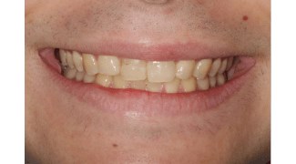 Before and After photos Before