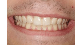 Before and After photos After