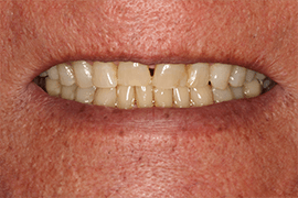 Smile Makeover B & A Before