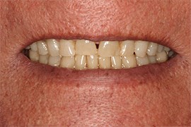 Smile Makeover B & A Before