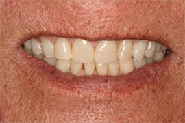 Smile Makeover B & A After